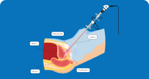 Laser Prostate Surgery, Bipolar TURP